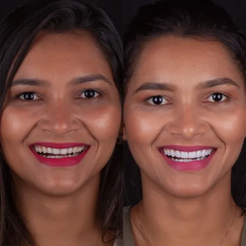 Resultado de facetas de porcelana — Dr. Márcio Pinto