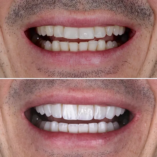 Antes e depois de lentes de contato dental — Dr. Márcio Pinto