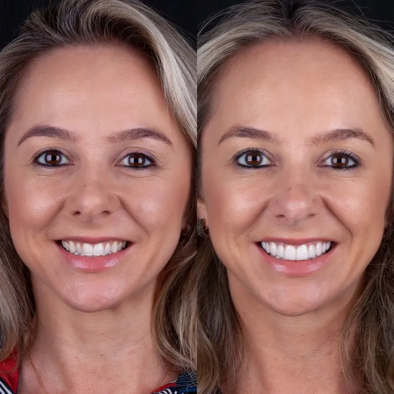 Caso real — antes e depois facetas de porcelana, Dr. Márcio Pinto